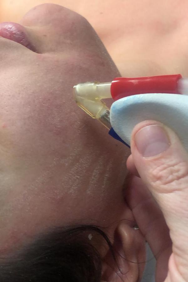 Microdermobrasione Piacenza